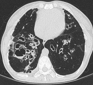 Cystic Bronchiectasis