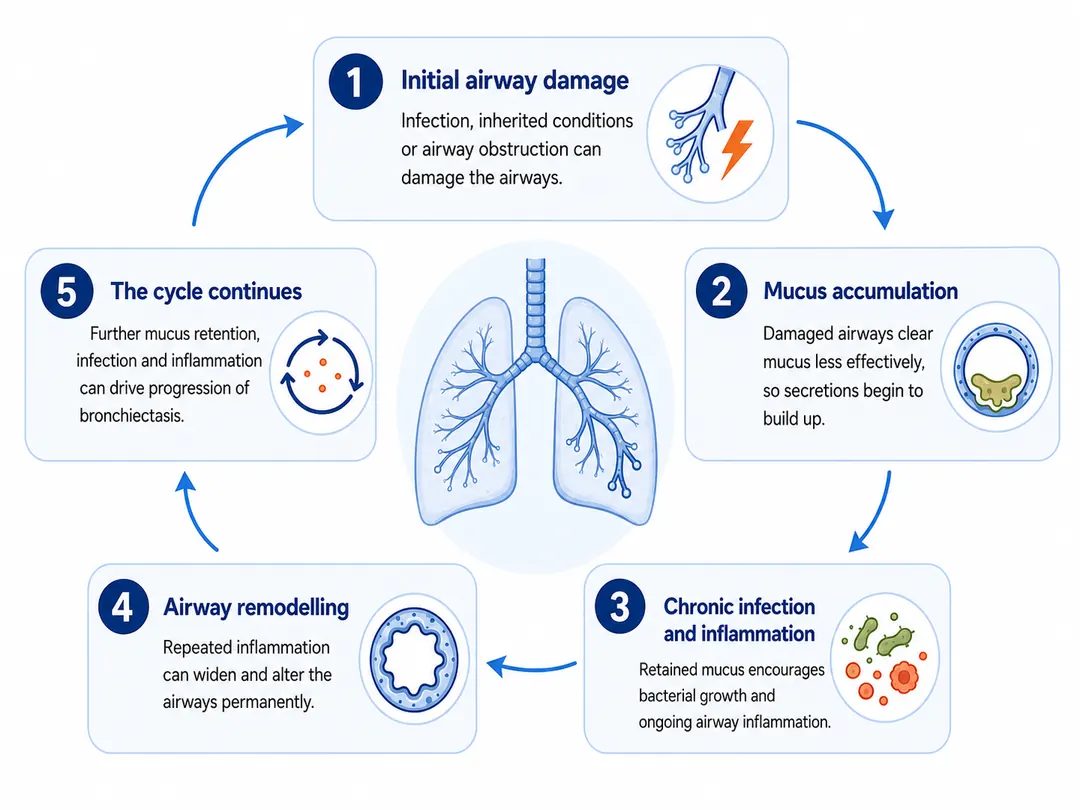 Diagram showing how airway damage, mucus build-up, infection and inflammation can lead to bronchiectasis.