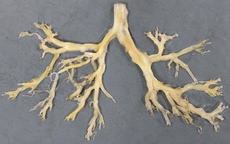 Plastic bronchitis